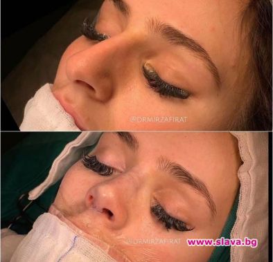 Ето как оперират носа на Преслава 
