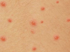 Инкубационният период е 21 дни. Родителите, които не са изкарали заболяването, трябва да са под карантина.
