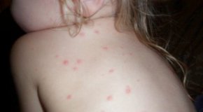 През миналата седмица има и два случая на скарлатина. Заболелите са деца на 4 и 7 години.

