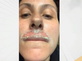  Жена е обезобразена след дерматологична процедура с лазер