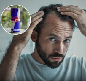 Coca-Cola и енергийни напитки носят плешивост и тревожност: Изследване