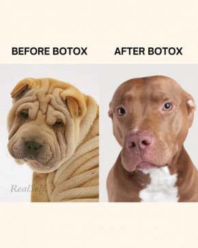 Смях: Преди ботокс, след ботокс