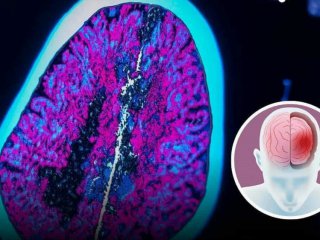 Мозъкът се самоизяжда без сън: Изследване