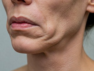 ОК-хранително поведение вместо увиснали, а после по-дебели след Оземпик: Как?