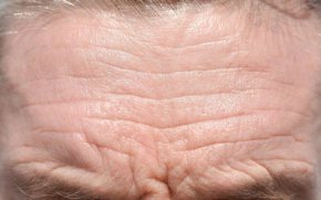 Дълбоките бръчки на челото може да са ранен признак за сърдечно заболяване